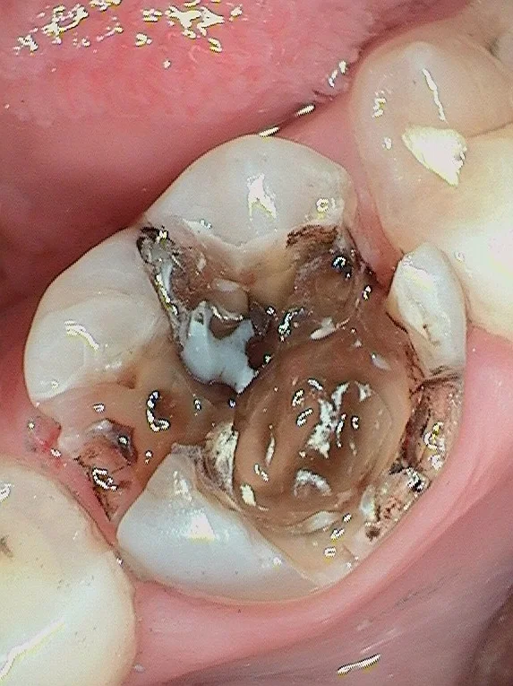 this is what we found when we remove the old silver filling.