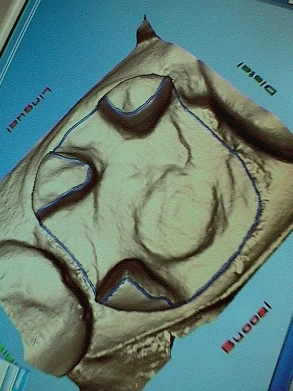 after we removed all the decay, we made a 3D image with the computer and this is the screen shot. you can see we were able to leave 3 islands of enamel (at 6, 9 and 12 o'clock).