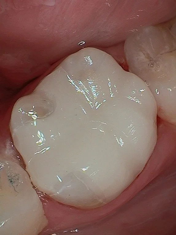 this is the final restoration, minutes after cementing the porcelain puzzle piece the cerec machine created for us. This restoration was still in service 9 years later!