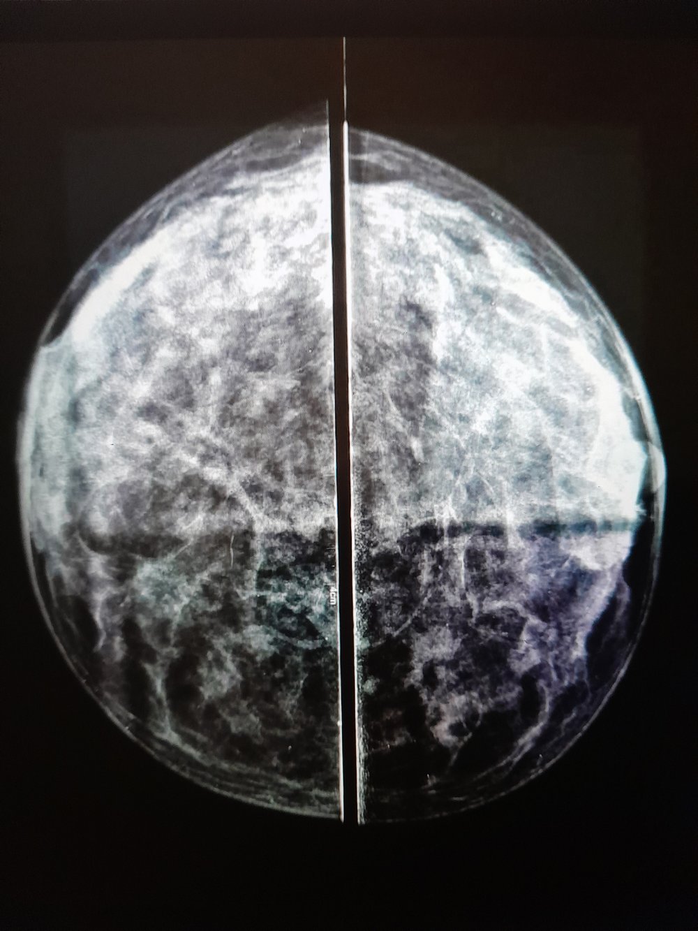 T Lyons Lunar breast 2019.jpg