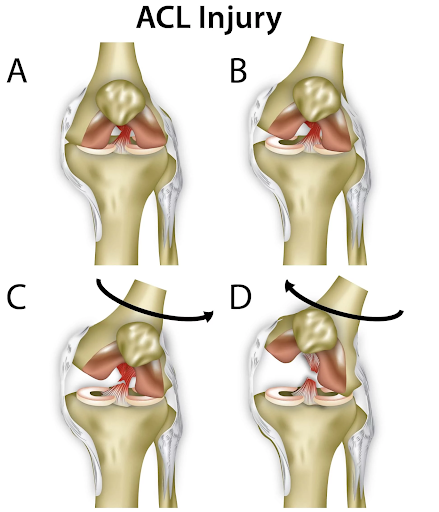 Croydon Physio - ACL Tear
