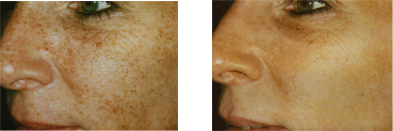 light therapy from synergy spa can help reveal your natural beauty