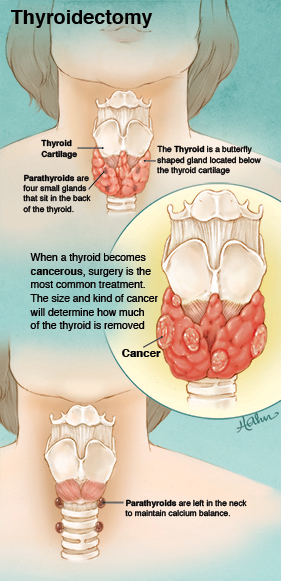 Thyroidectomy in Patient Education