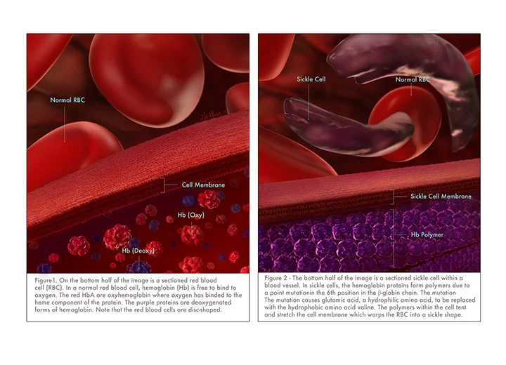 Hemoglobin in Sickle Cell anemia