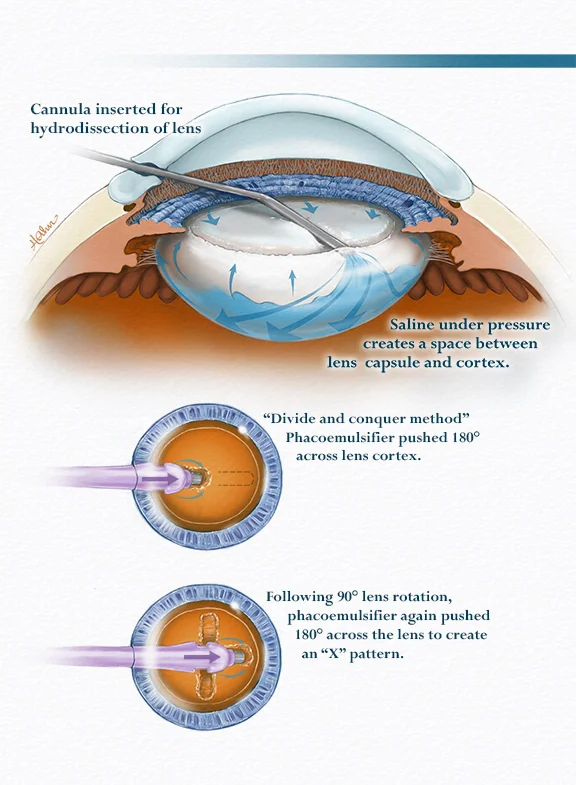 Cataract Extraction