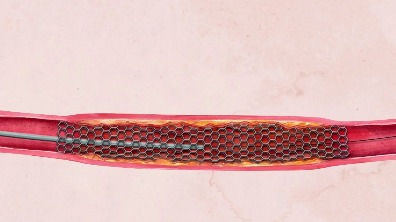 Critical Limb Ischemia  Treatment