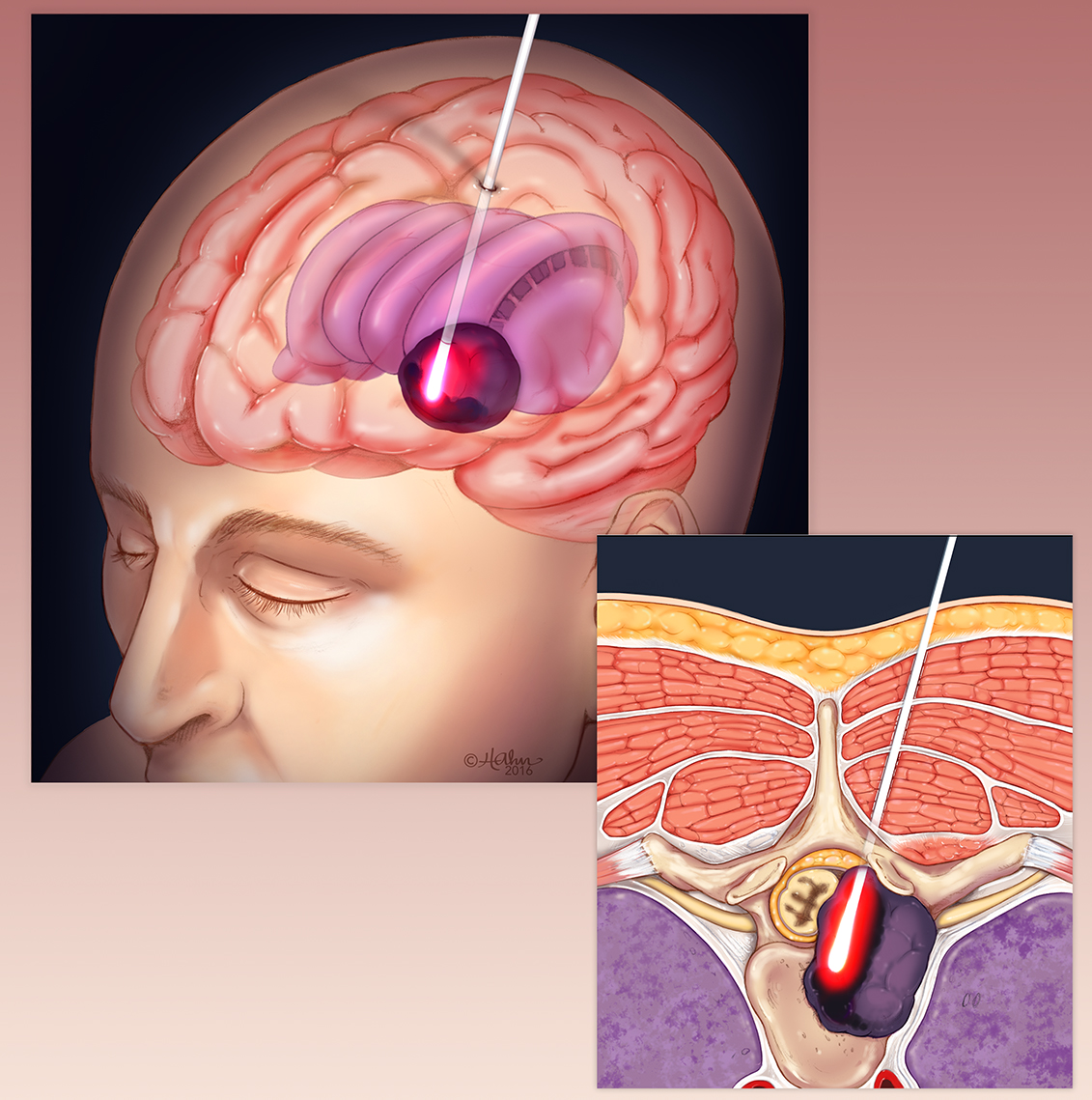 Laser Interstitial Thermal Therapy (LITT) in Neurosurgery