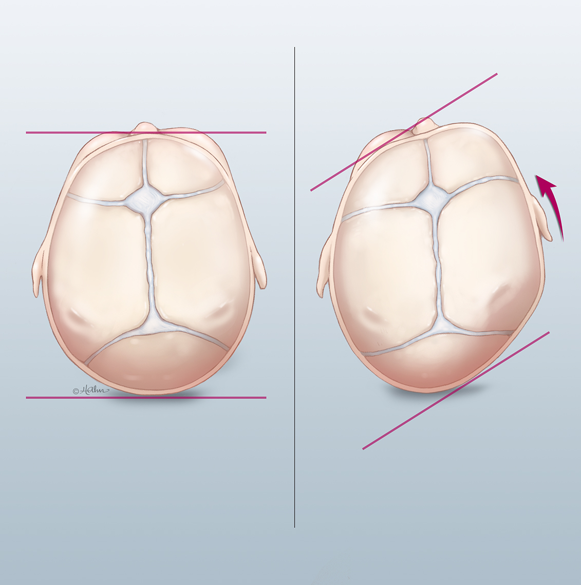 Plagiocephaly