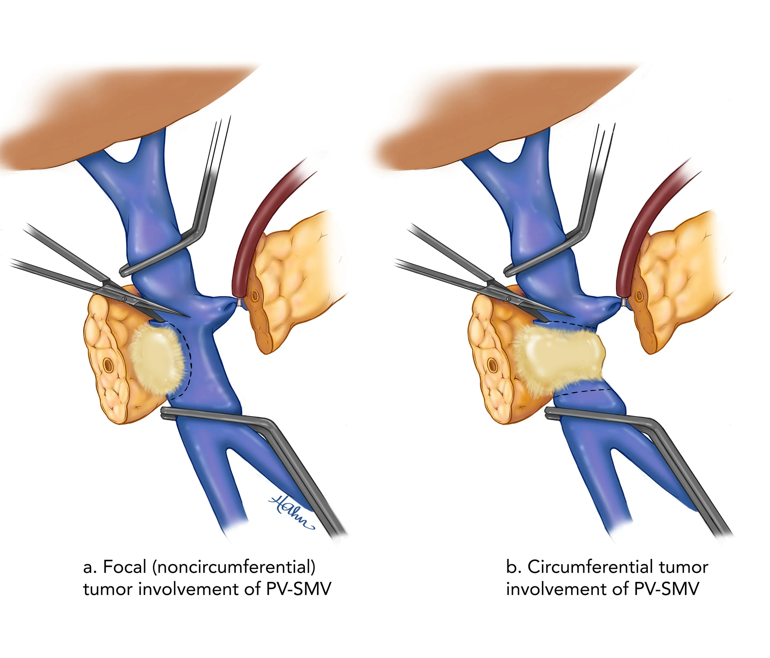 tumorresection.jpg