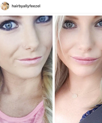 My Lip filler before and after!