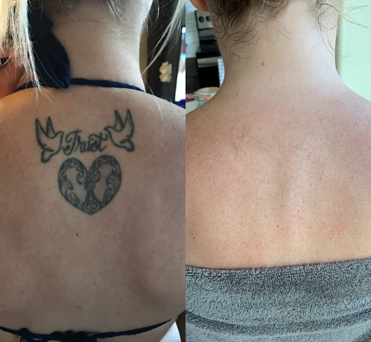 My tattoo removal experience — Beauty and the blonde