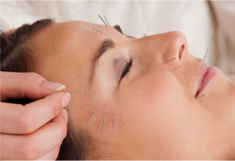 Facial Rejuvenation Cosmetic Acupuncture
