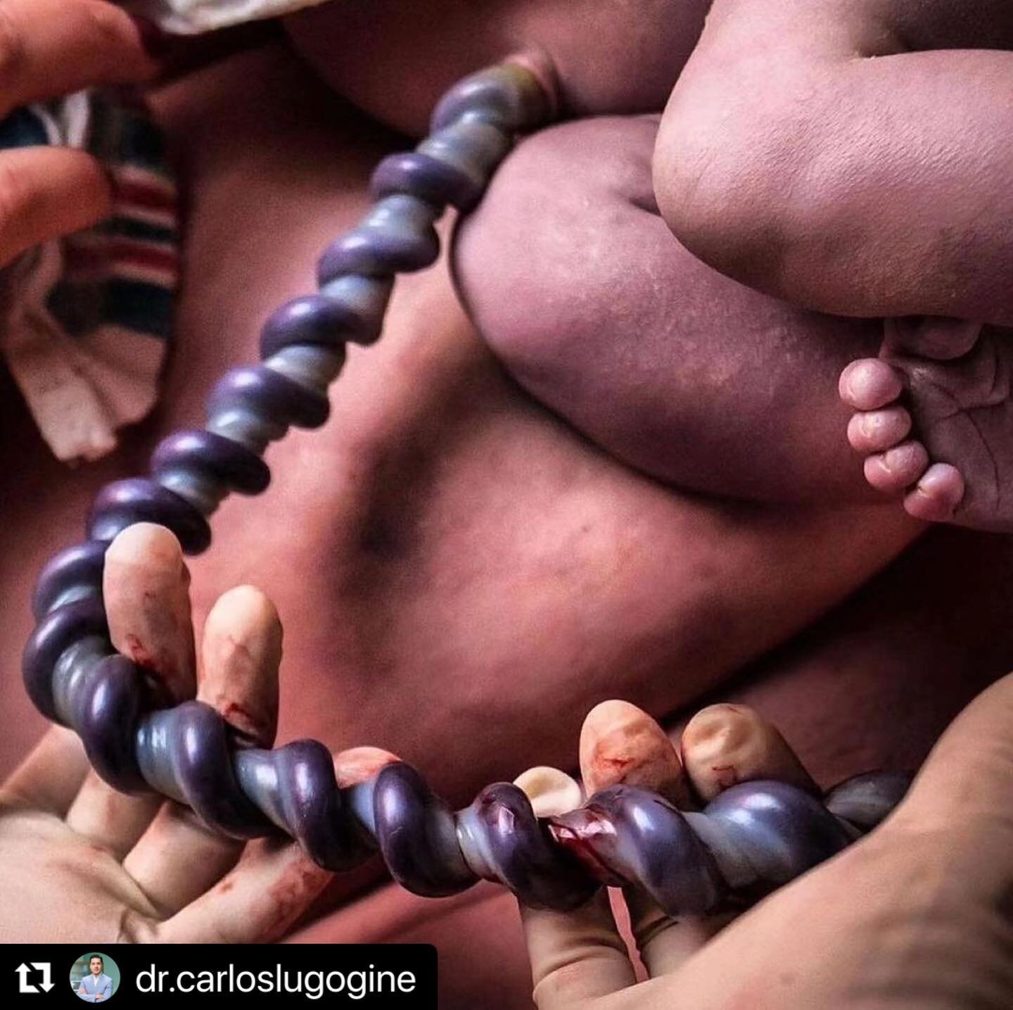 #Repost @dr.carloslugogine with @use.repost
・・・
El cord&oacute;n umbilical tiene una de las funciones m&aacute;s importantes en el embarazo, pues es el encargado de transportar ox&iacute;geno y nutrientes de mam&aacute; a beb&eacute; as&iacute; como 