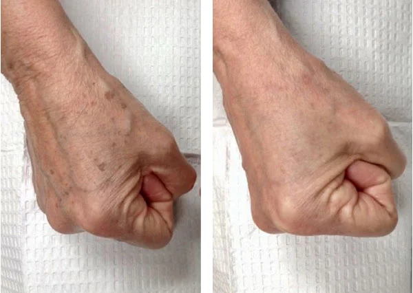 Before and After (unedited photos of an actual River Ridge Dermatology patient. INDIVIDUAL RESULTS MAY VARY.)