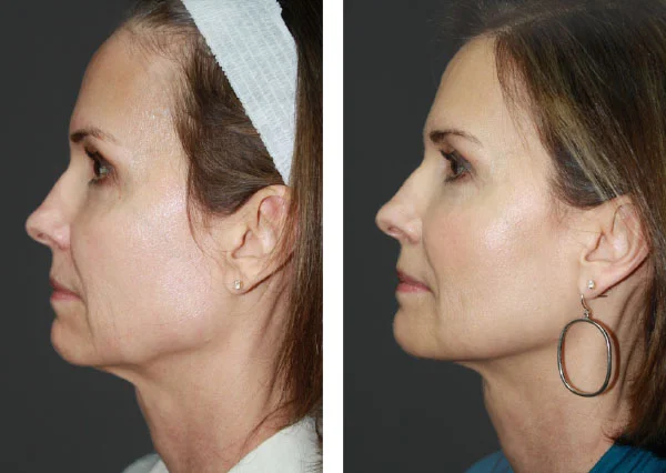 Before and After (unedited photos of an actual River Ridge Dermatology patient).* *INDIVIDUAL RESULTS MAY VARY