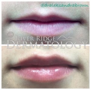 Before and After (unedited photos of an actual River Ridge Dermatology patient).* *individual results may vary.