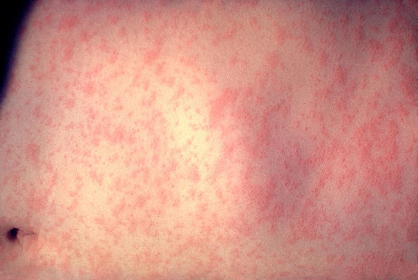 Morbillivirus_measles_infection.jpg