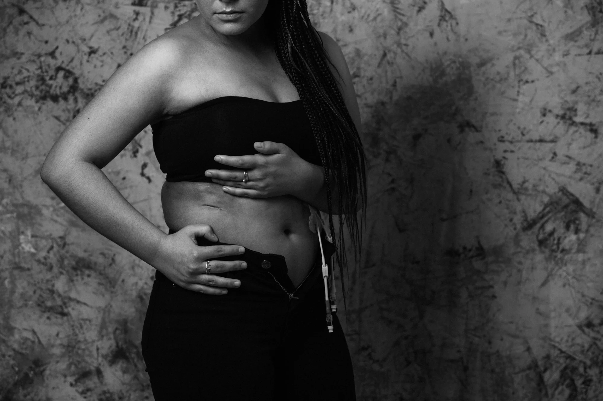 Scar Stories is the incredible initiative of founder Jasmine Gailer who in 2011 found strength and determination through photographing and sharing her cancer scar. Empowered and motivated she established Scar Stories to help other young adult cancer patients see their scars and themselves in a new light. Via various creative initiatives Scar Stories raises awareness of young adult cancer as well as funds to develop support programs and provide much needed specialty care for young adults battling cancer. It is my joy and privilege to be a Scar Stories creative partner and support the fantastic work and services provided Scar Stories.