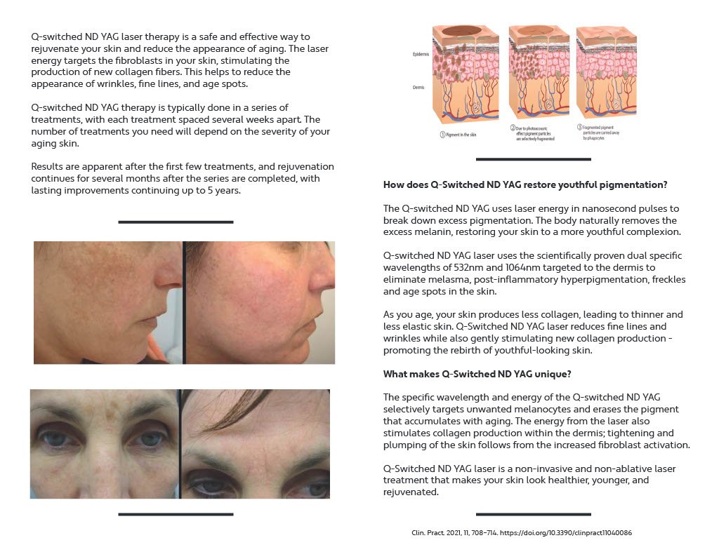 Q Switched Ruby Laser — Board Certified Dermatology