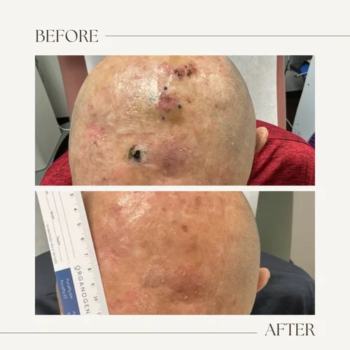 Before and after electronic brachytherapy for skin cancer, Alpha Dermatology case 14