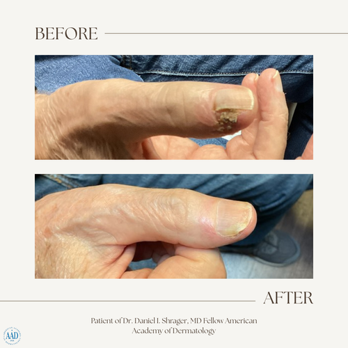 Before and after electronic brachytherapy for skin cancer, Alpha Dermatology case 9