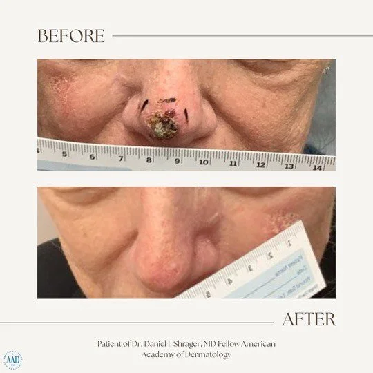 Nasal tip skin cancer before and after electronic brachytherapy