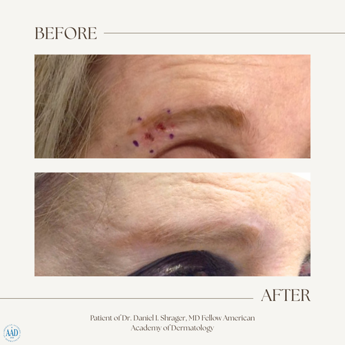 Before and after electronic brachytherapy for skin cancer, Alpha Dermatology case 24