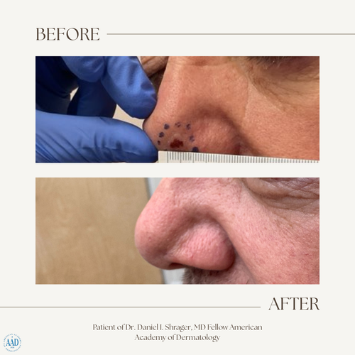 Before and after electronic brachytherapy for skin cancer, Alpha Dermatology case 5