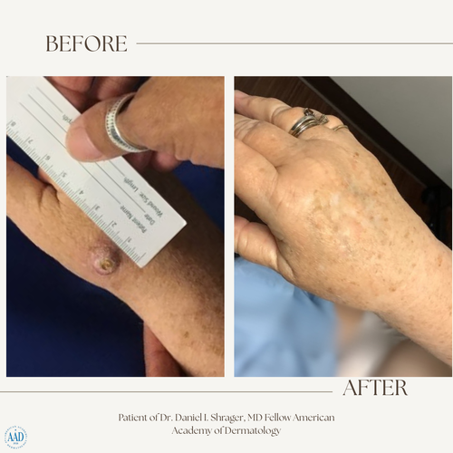 Before and after electronic brachytherapy for skin cancer, Alpha Dermatology case 6
