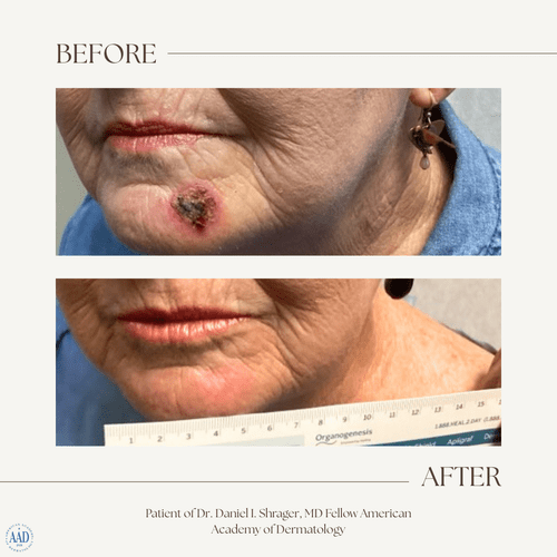 Before and after electronic brachytherapy for skin cancer, Alpha Dermatology case 10