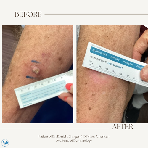 Before and after electronic brachytherapy for skin cancer, Alpha Dermatology case 7