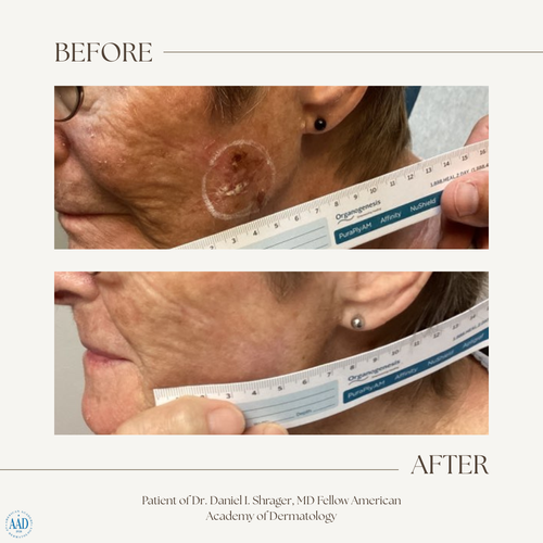 Before and after electronic brachytherapy for skin cancer, Alpha Dermatology case 21