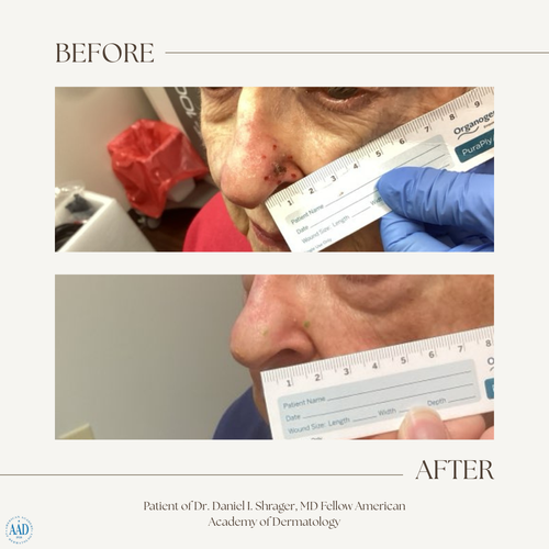 Before and after electronic brachytherapy for skin cancer, Alpha Dermatology case 29