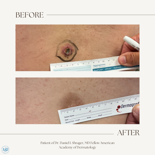 Before and after electronic brachytherapy for skin cancer, Alpha Dermatology case 12