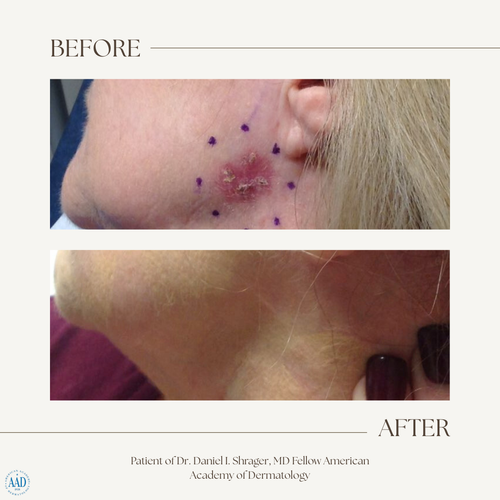 Before and after electronic brachytherapy for skin cancer, Alpha Dermatology case 11