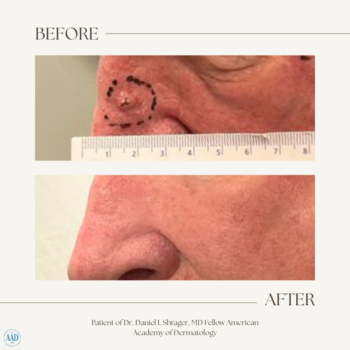 Before and after electronic brachytherapy for skin cancer, Alpha Dermatology case 18