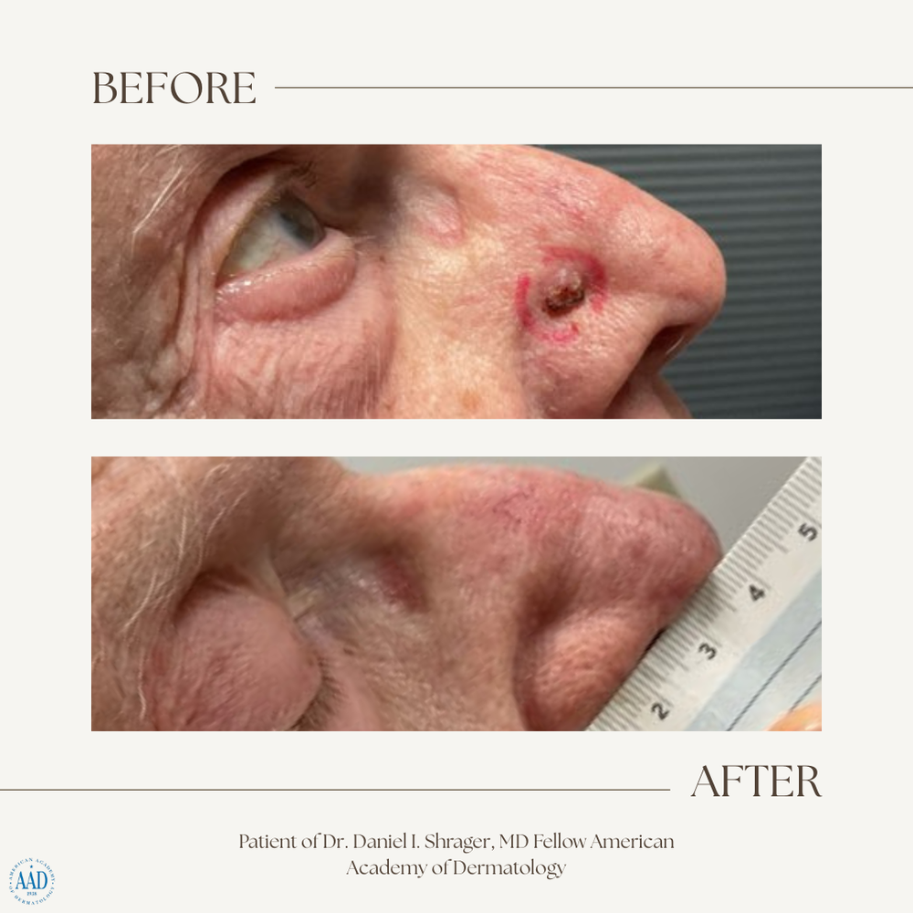 Before and after electronic brachytherapy treatment of a basal cell carcinoma on the nose