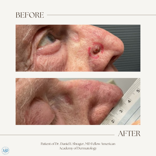 Before and after electronic brachytherapy for skin cancer, Alpha Dermatology case 1