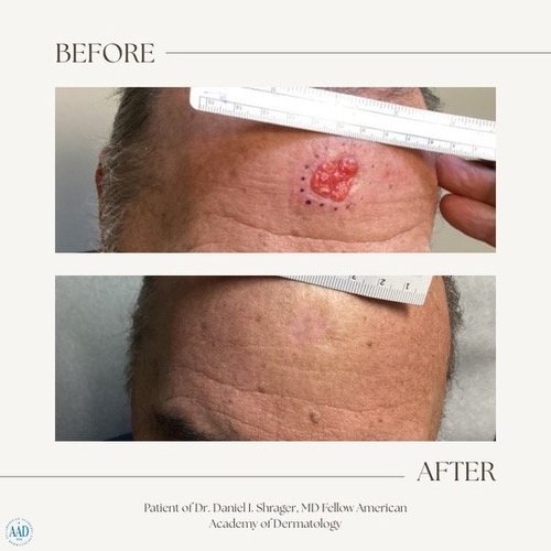 Before and after electronic brachytherapy for skin cancer, Alpha Dermatology case 4