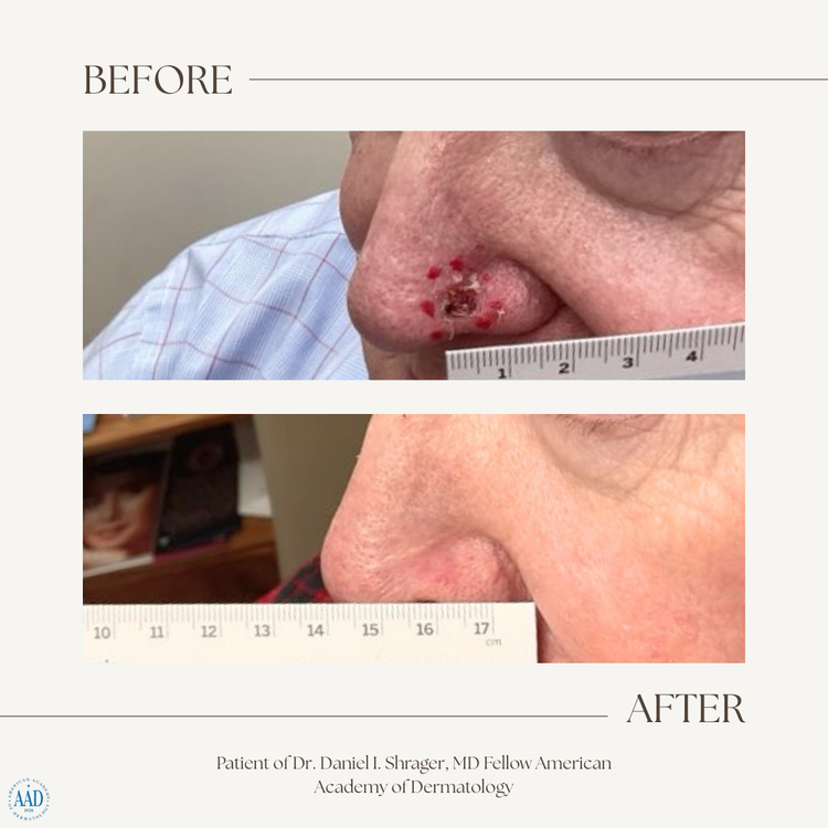 Nose skin cancer before and after electronic brachytherapy