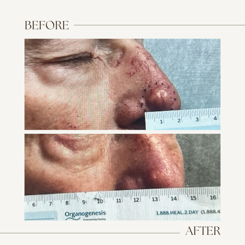 Before and after electronic brachytherapy for skin cancer, Alpha Dermatology case 30