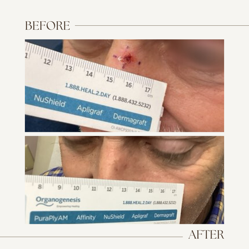 Before and after electronic brachytherapy for skin cancer, Alpha Dermatology case 8