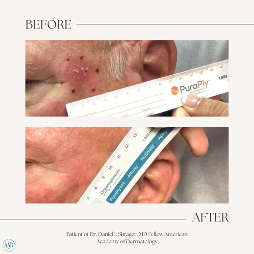 Before and after electronic brachytherapy for skin cancer, Alpha Dermatology case 26