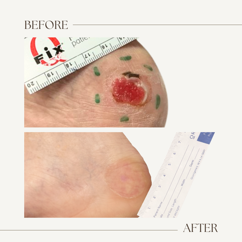 Before and after electronic brachytherapy for skin cancer, Alpha Dermatology case 31