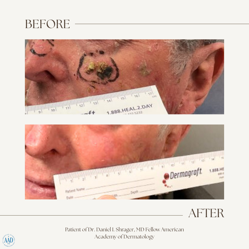 Before and after electronic brachytherapy for skin cancer, Alpha Dermatology case 25