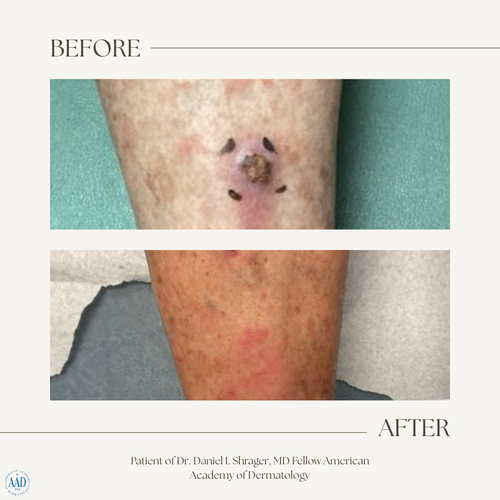 Before and after electronic brachytherapy for skin cancer, Alpha Dermatology case 15