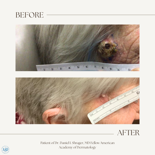 Before and after electronic brachytherapy for skin cancer, Alpha Dermatology case 28