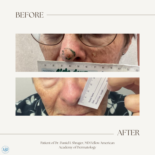 Before and after electronic brachytherapy for skin cancer, Alpha Dermatology case 13