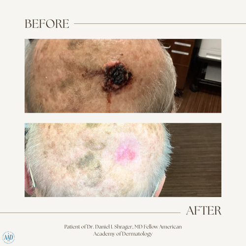 Before and after electronic brachytherapy for skin cancer, Alpha Dermatology case 2