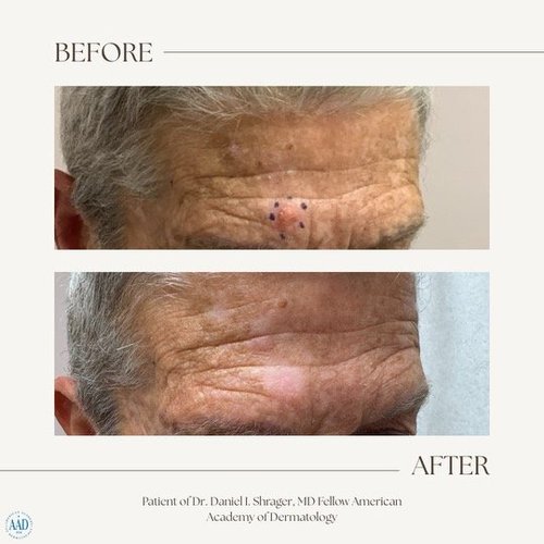 Before and after electronic brachytherapy for skin cancer, Alpha Dermatology case 19